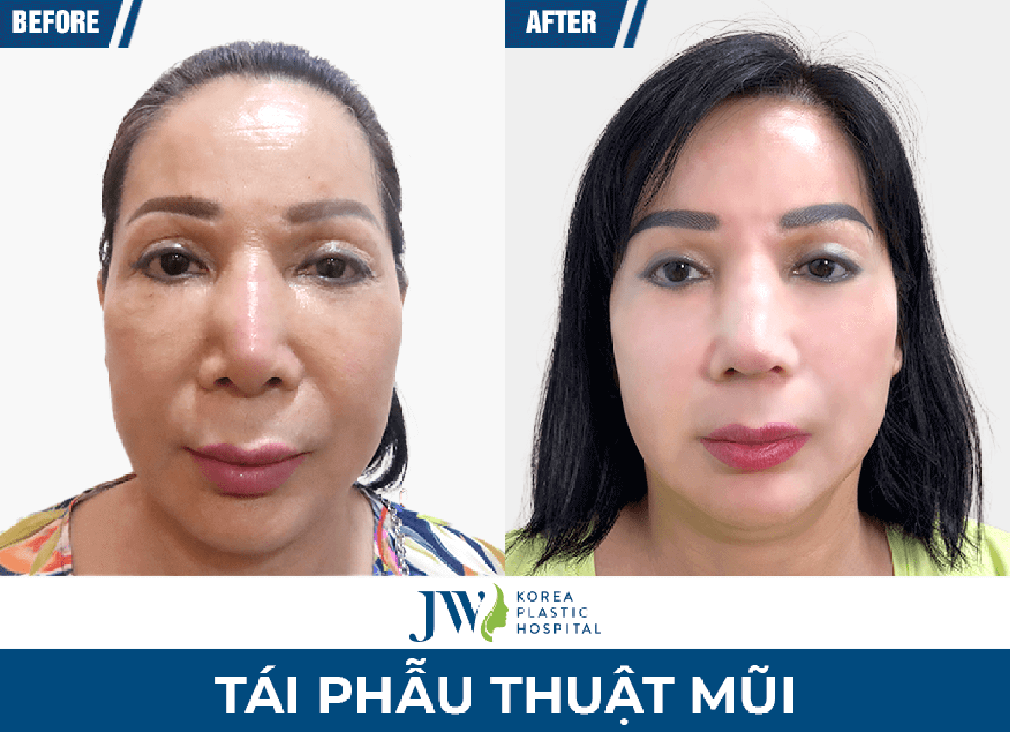ket-qua-sau-khi-tai-phau-thuat-mui-hong-tai-jw