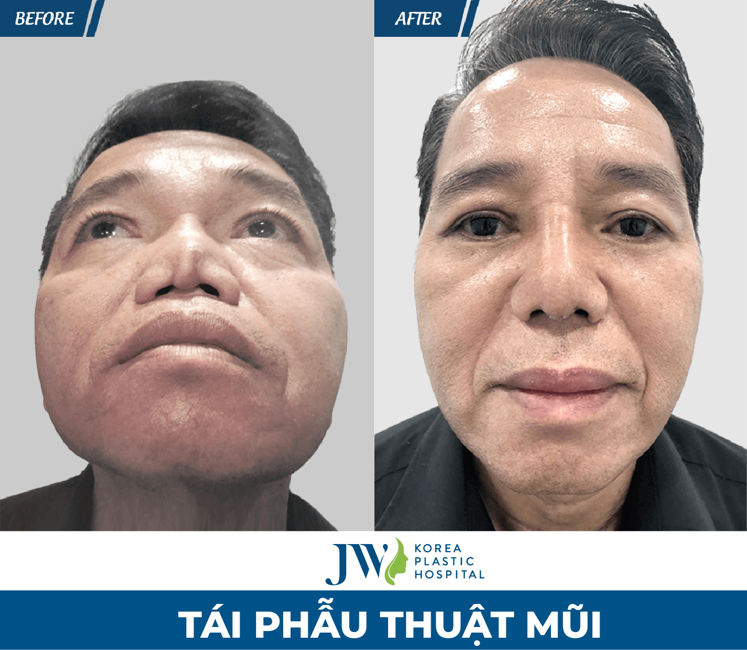 ket-qua-sau-khi-tai-phau-thuat-mui-hong-tai-jw1