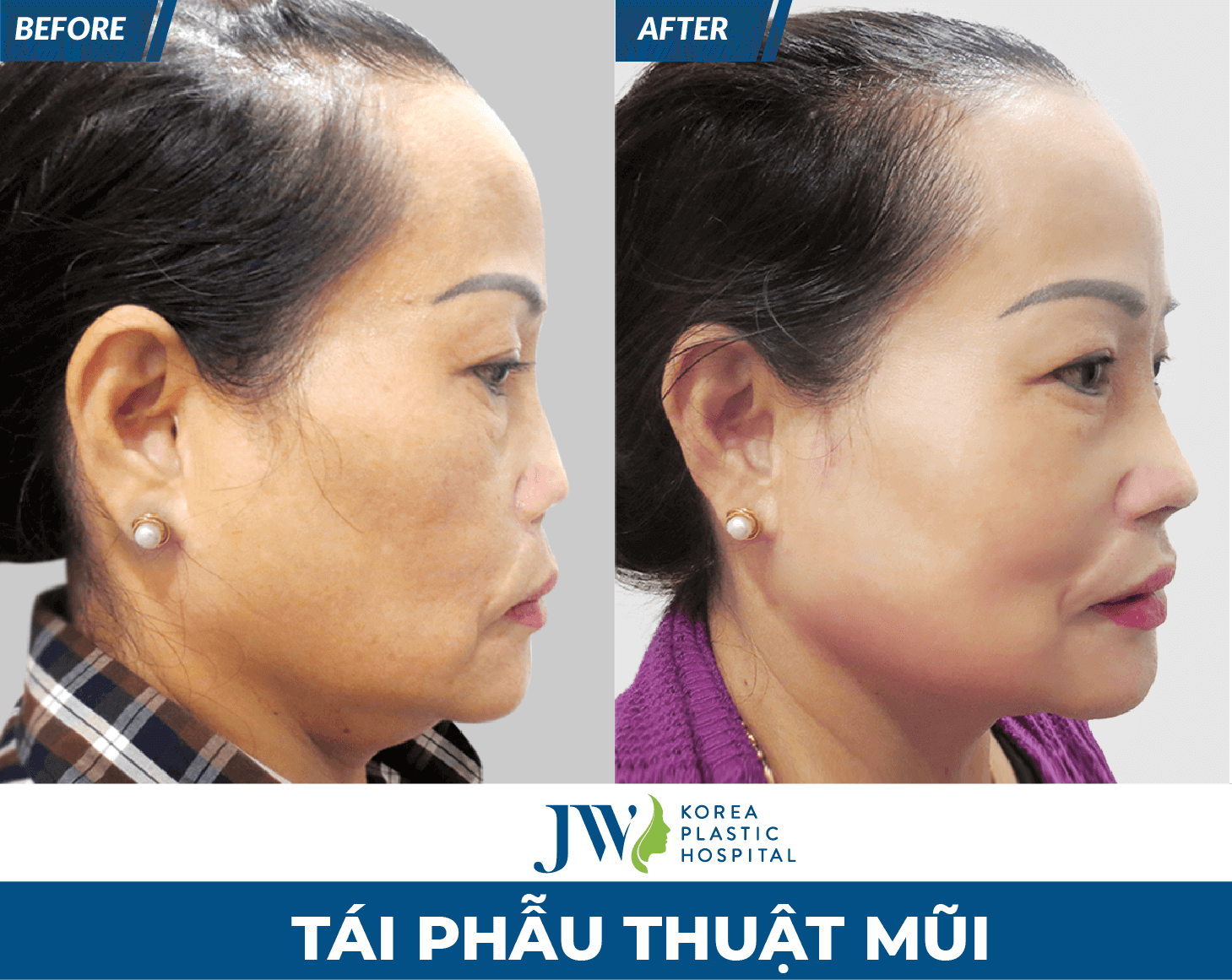ket-qua-sau-khi-tai-phau-thuat-mui-hong-tai-jw2