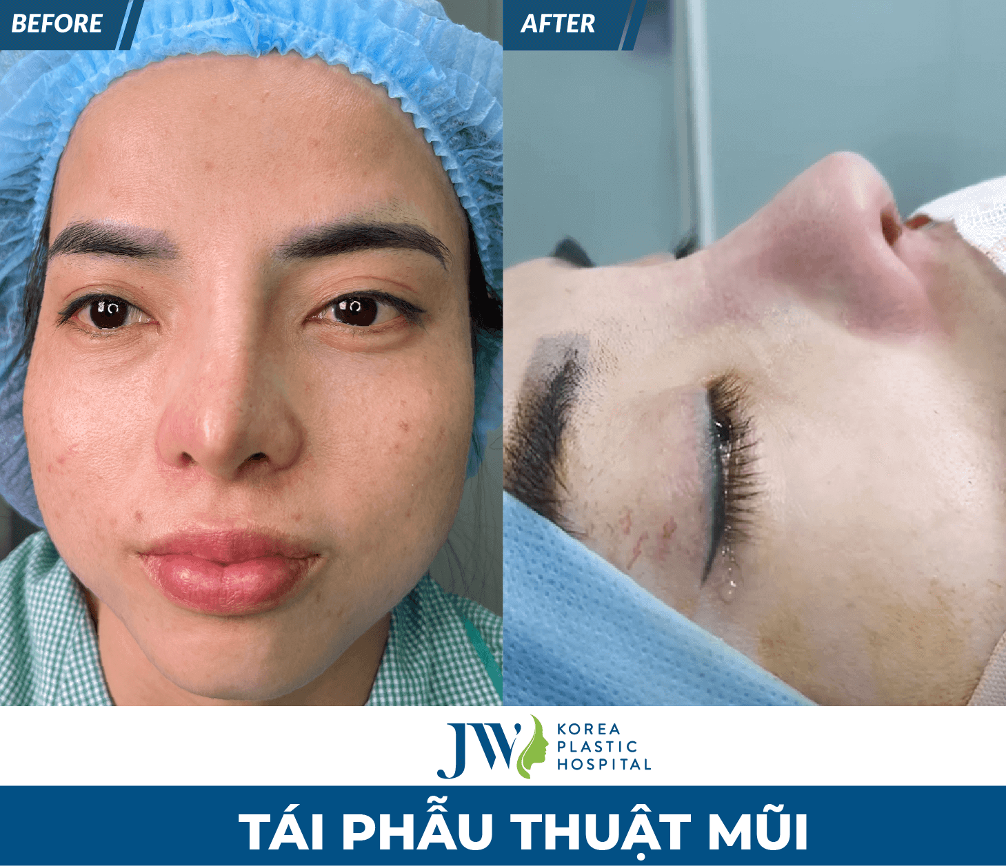 ket-qua-sau-khi-tai-phau-thuat-mui-hong-tai-jw3