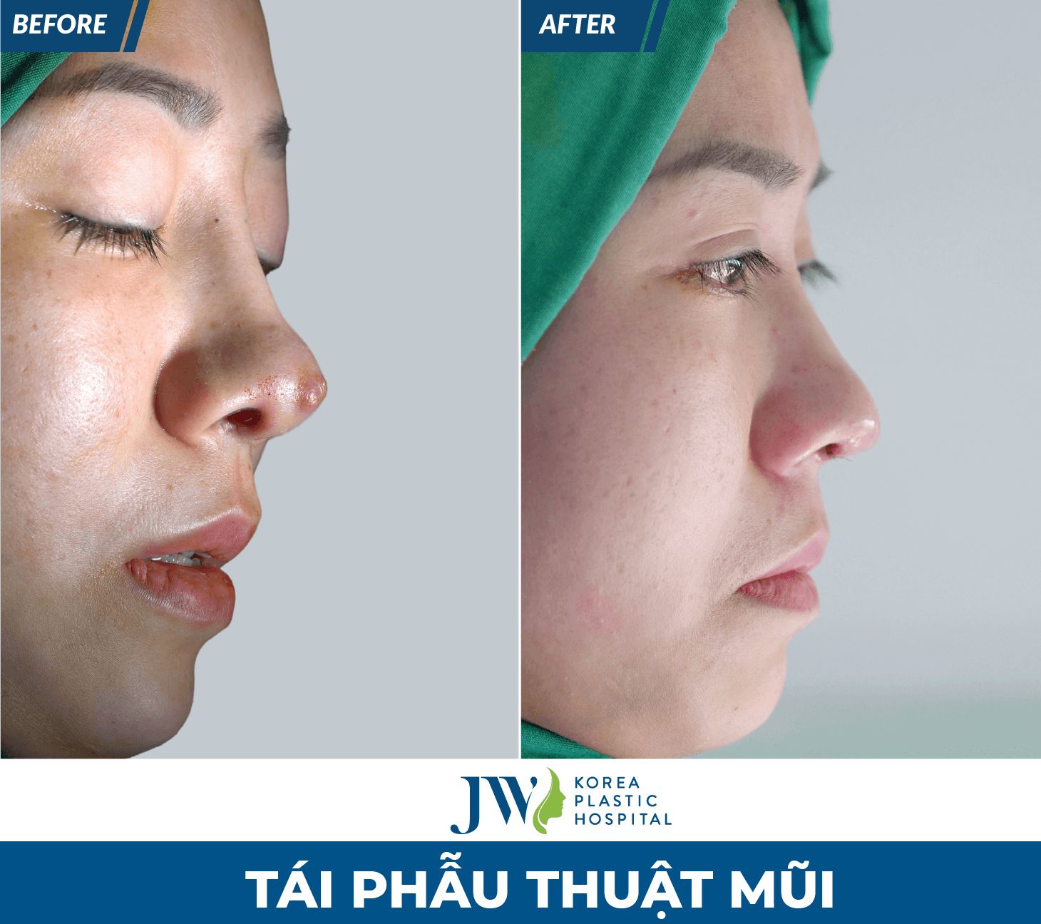 ket-qua-sau-khi-tai-phau-thuat-mui-hong-tai-jw4