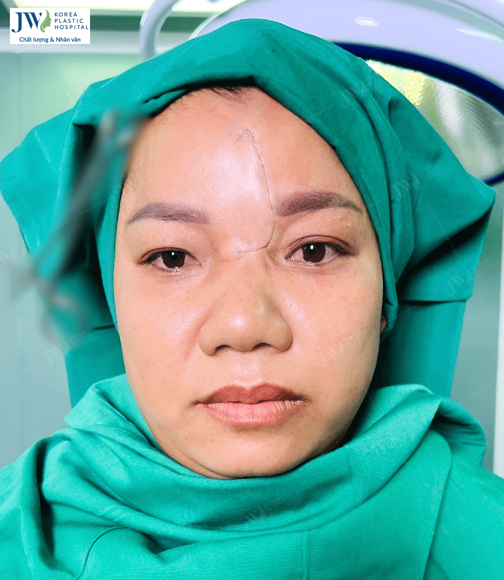 lung-tran-3