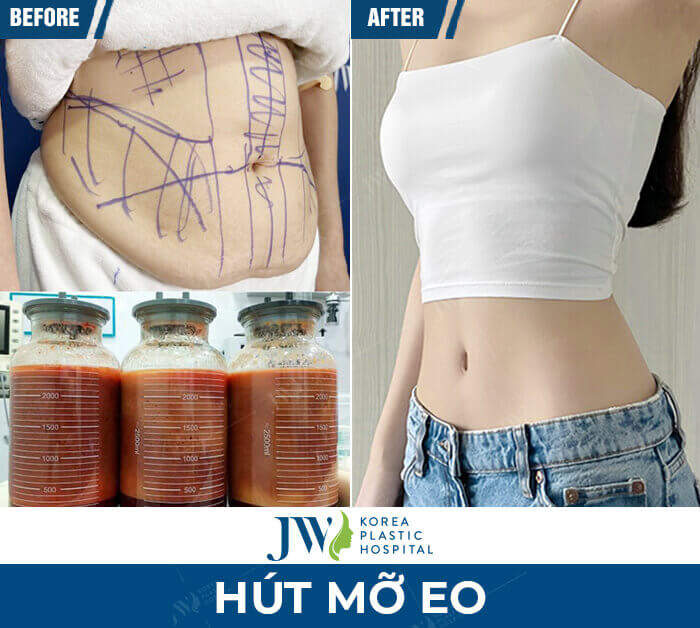 luu-y-khi-hut-mo-eo
