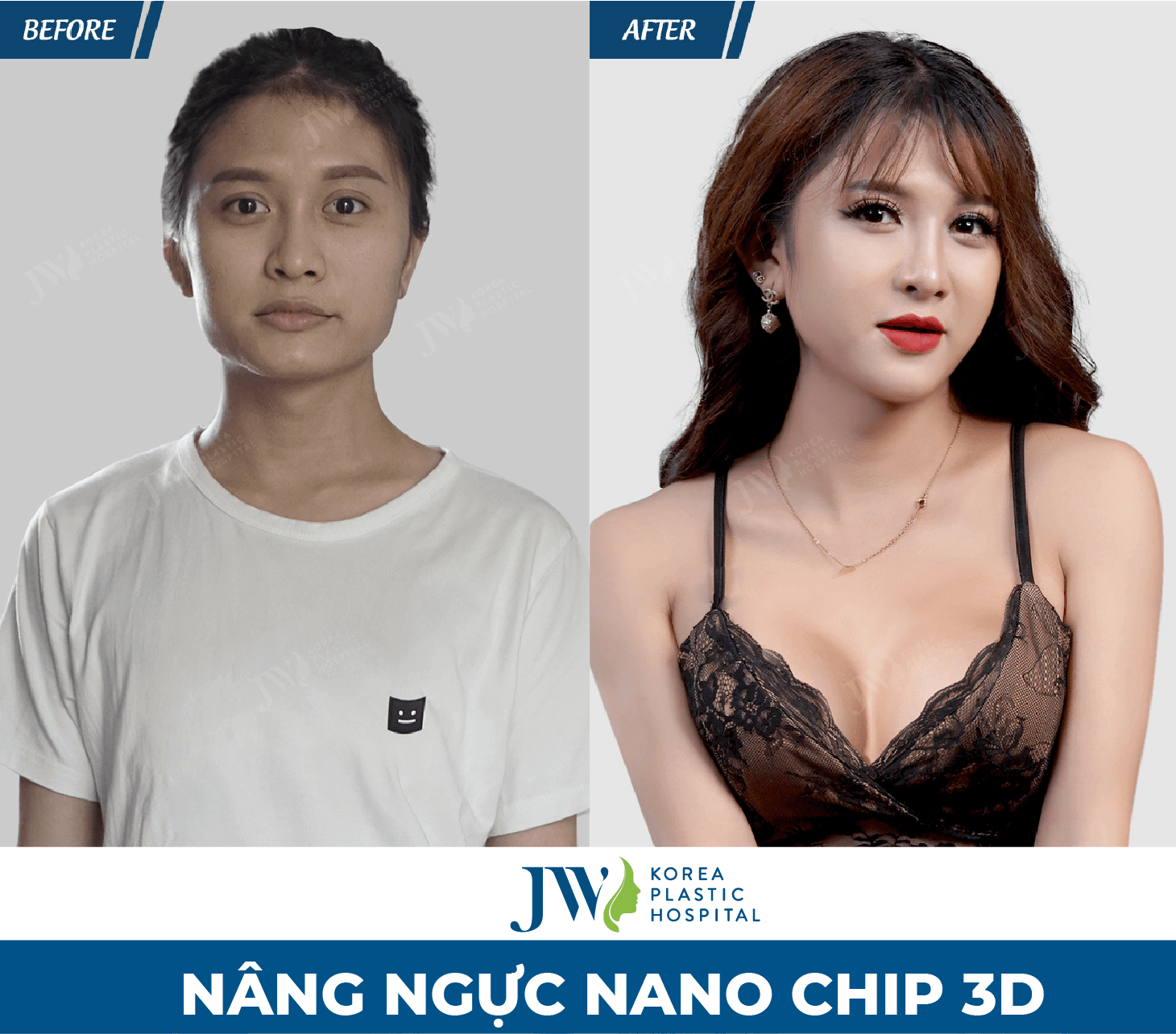 nang nguc nano chip demi