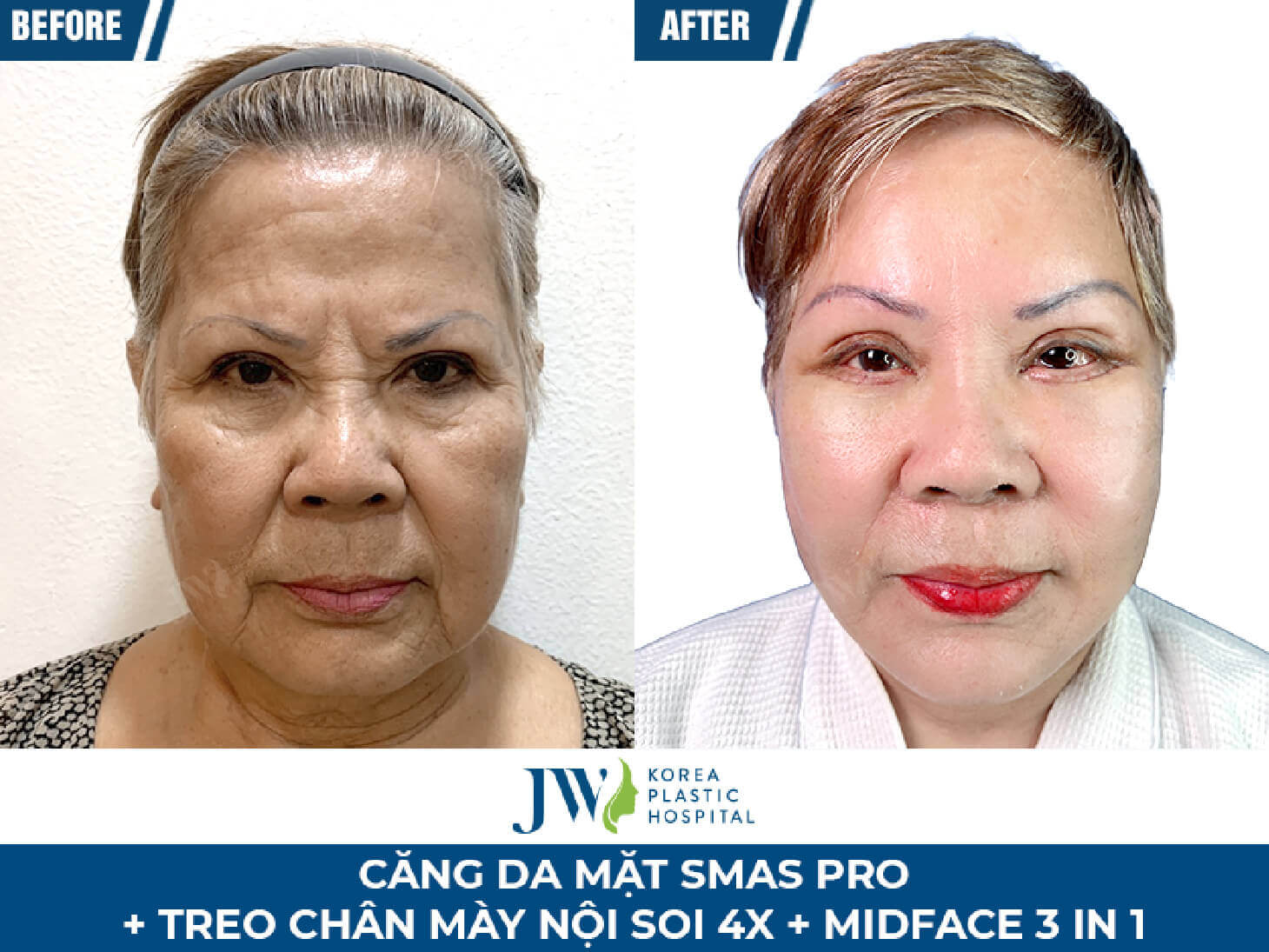 cang da mat smas pro