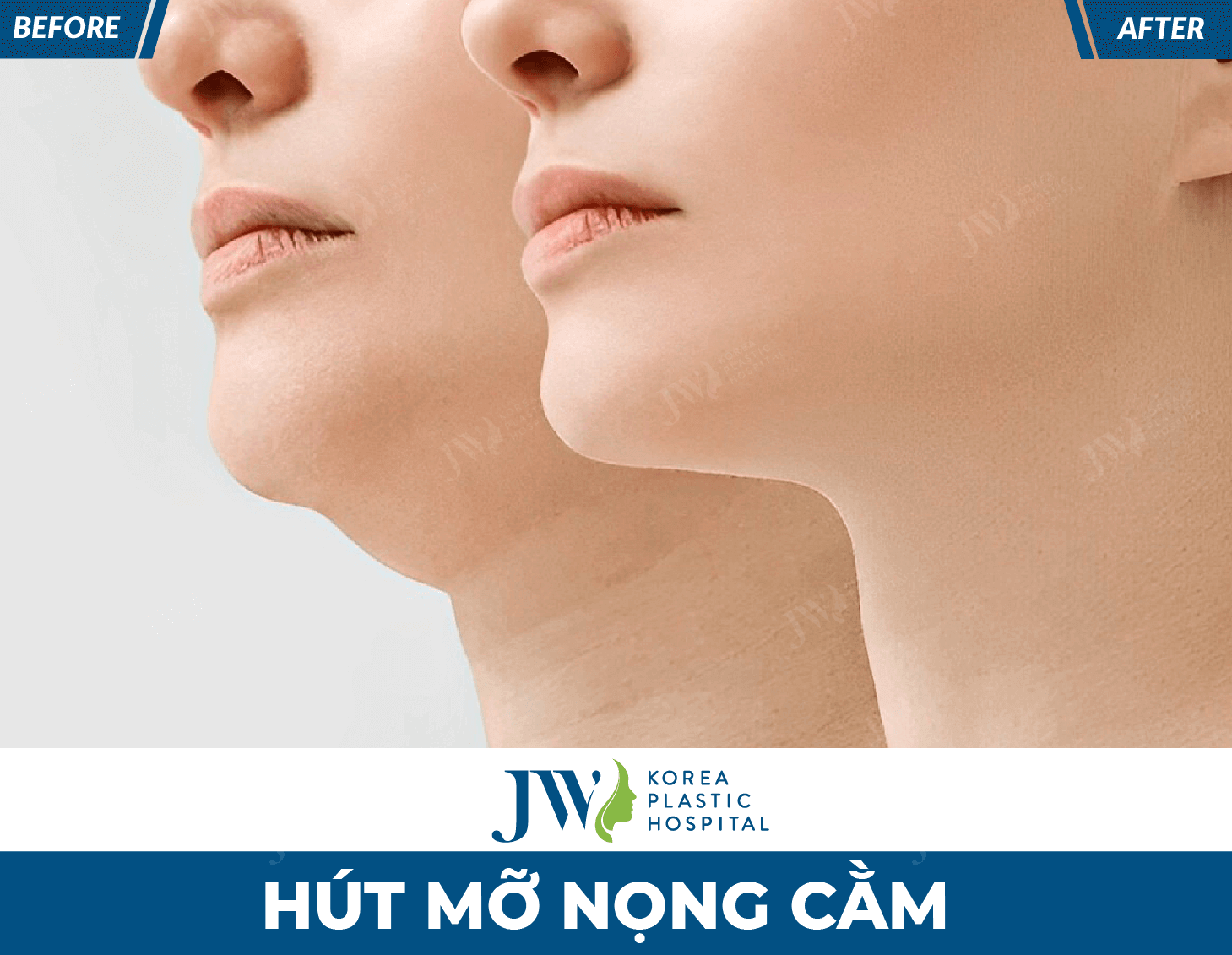hut mo nong cam