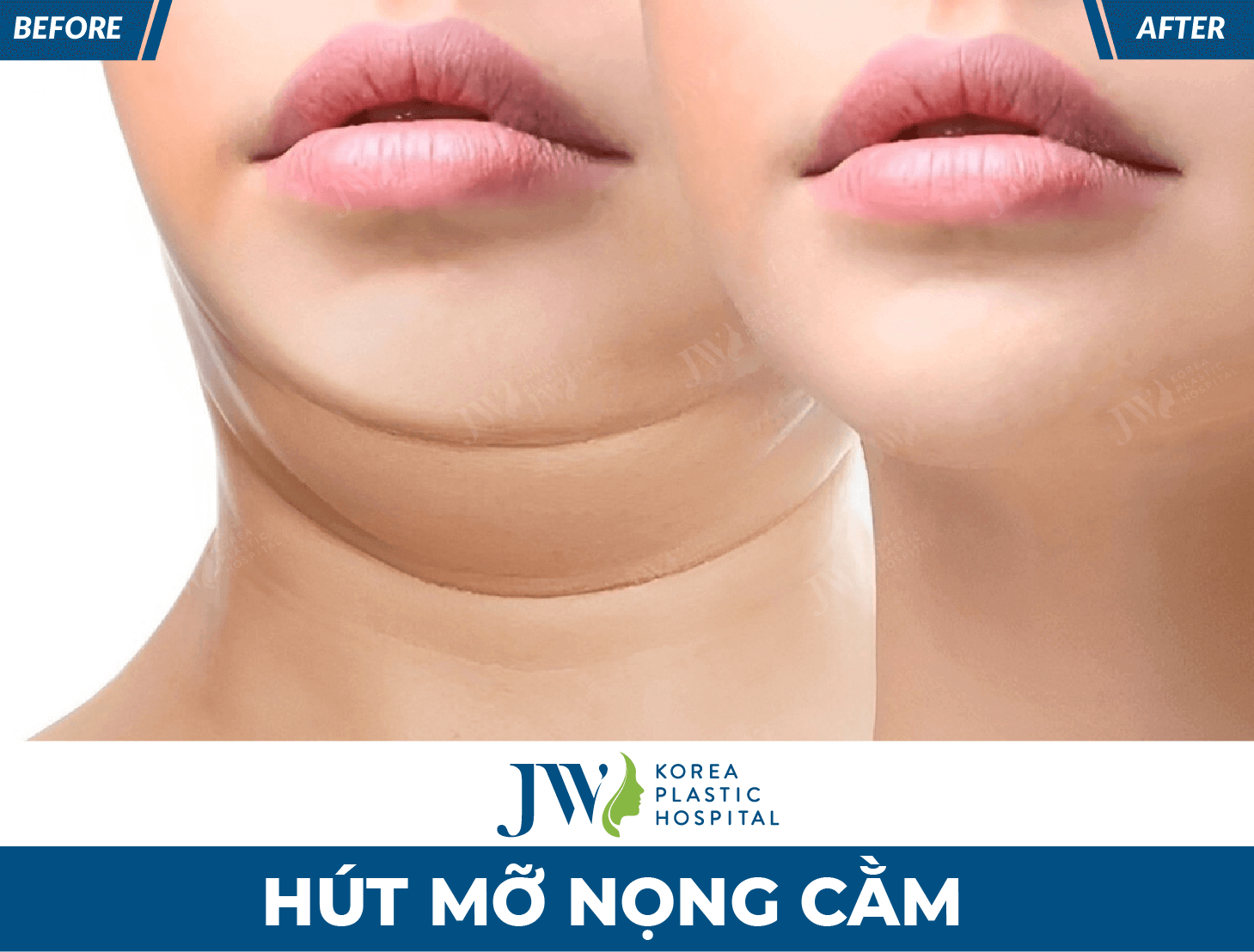 benh vien jw hut mo nong cam