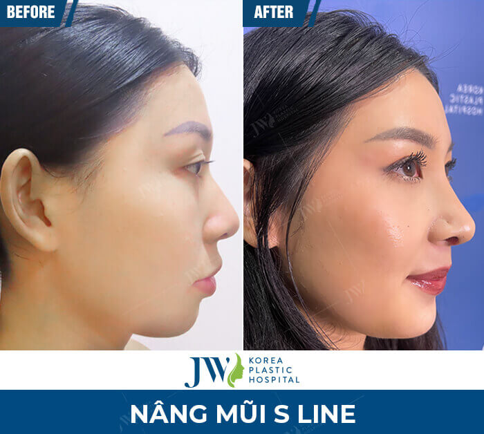 nang-mui-sline-2