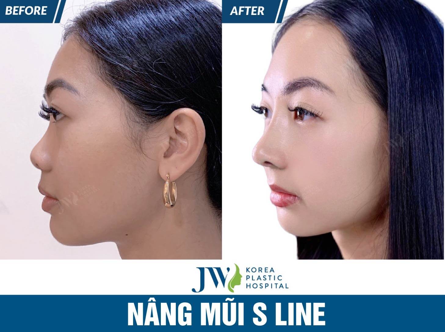 nang-mui-sline-3