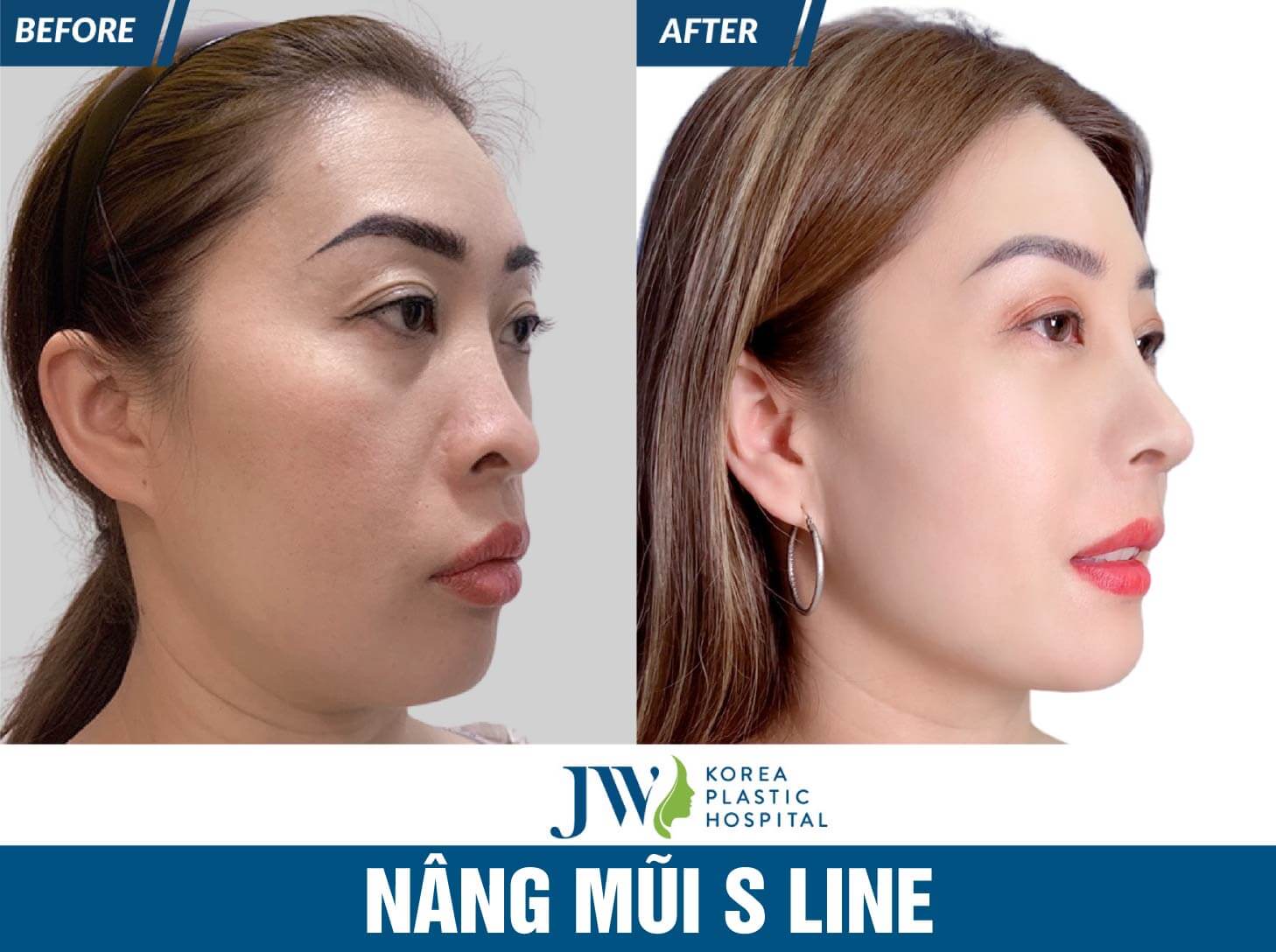 nang-mui-sline-4