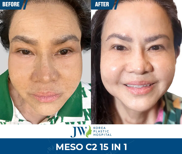 meso trang sang da