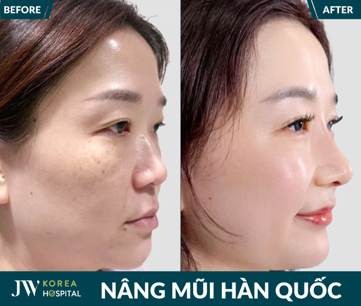 nang mui han quoc benh vien jw han quoc