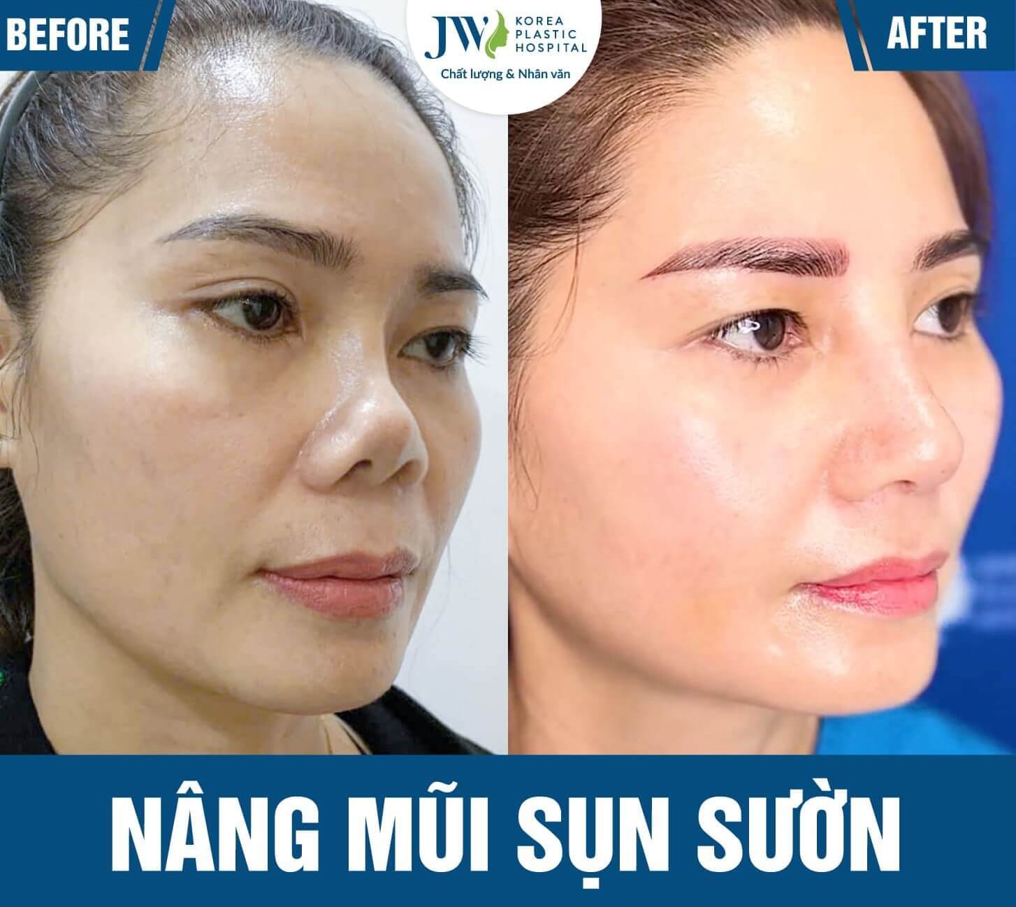 ket qua nang mui