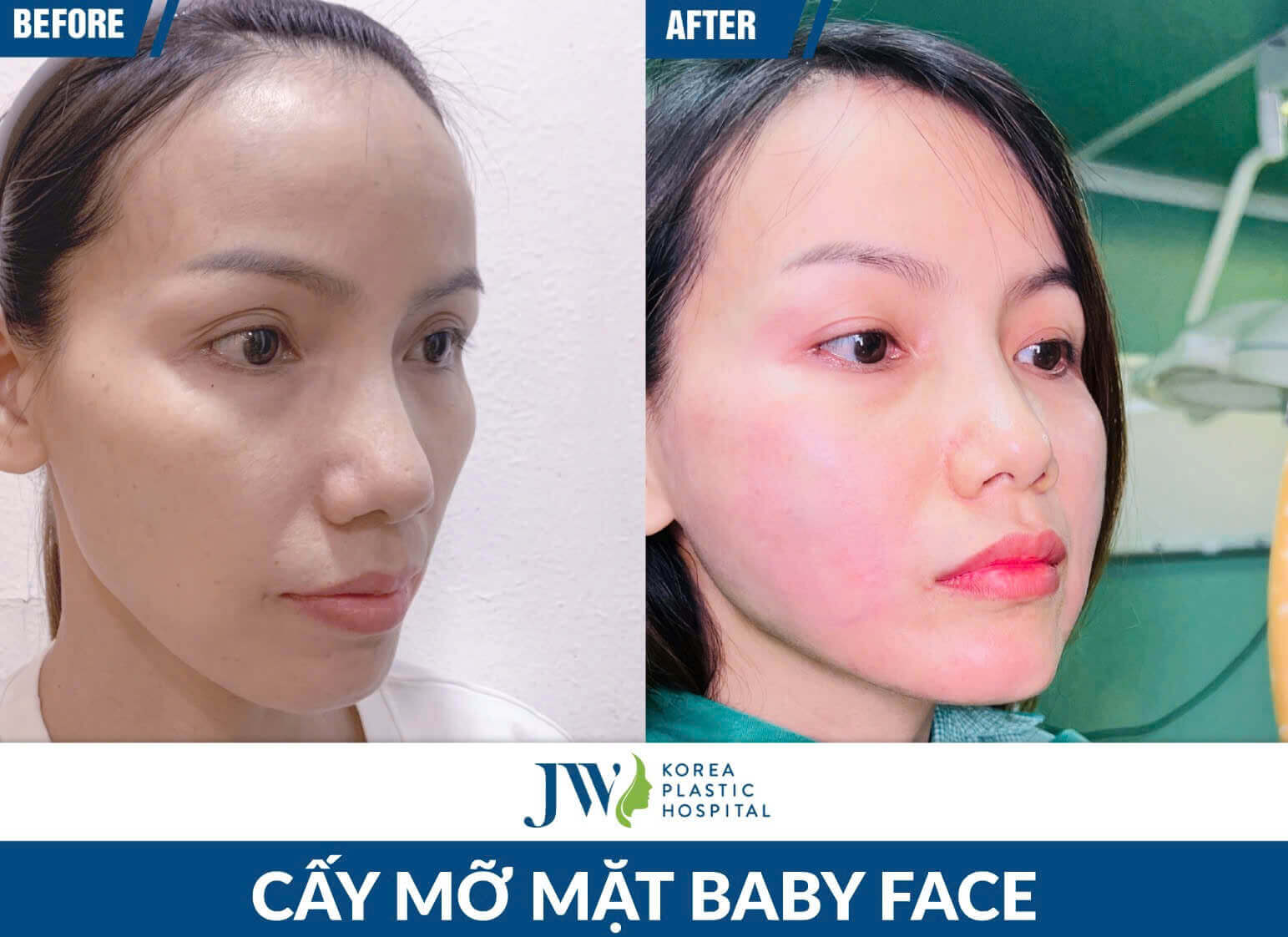 cay mo mat baby face