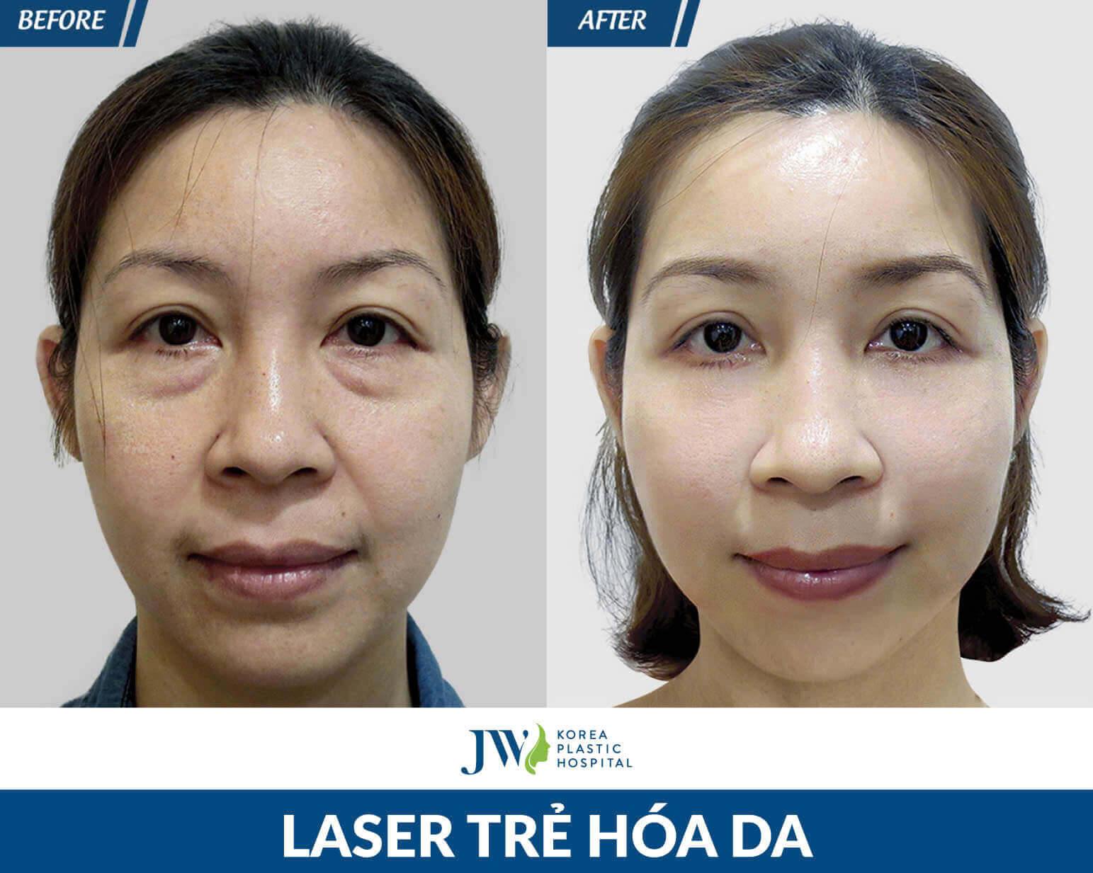 laser-tre-hoa-da