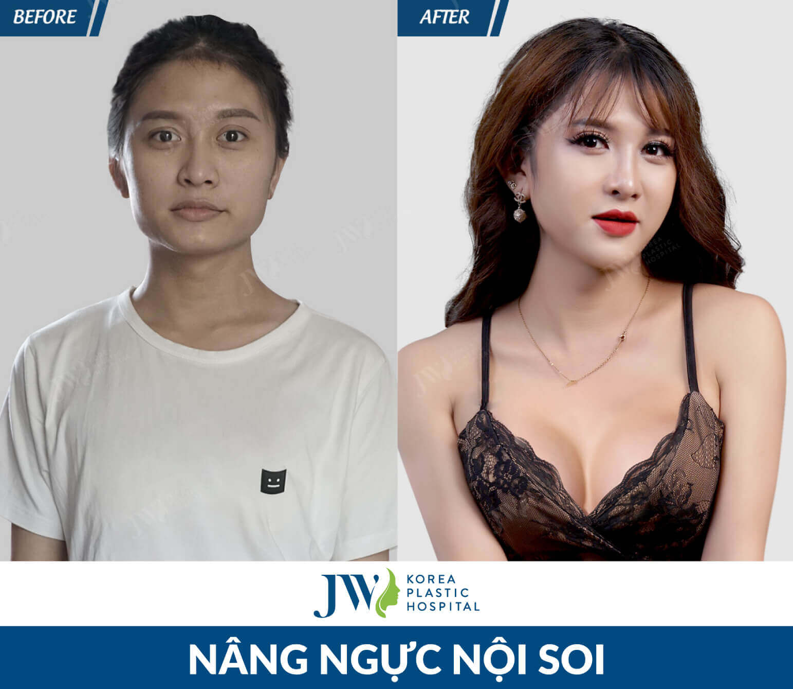 nang-nguc-noi-soi