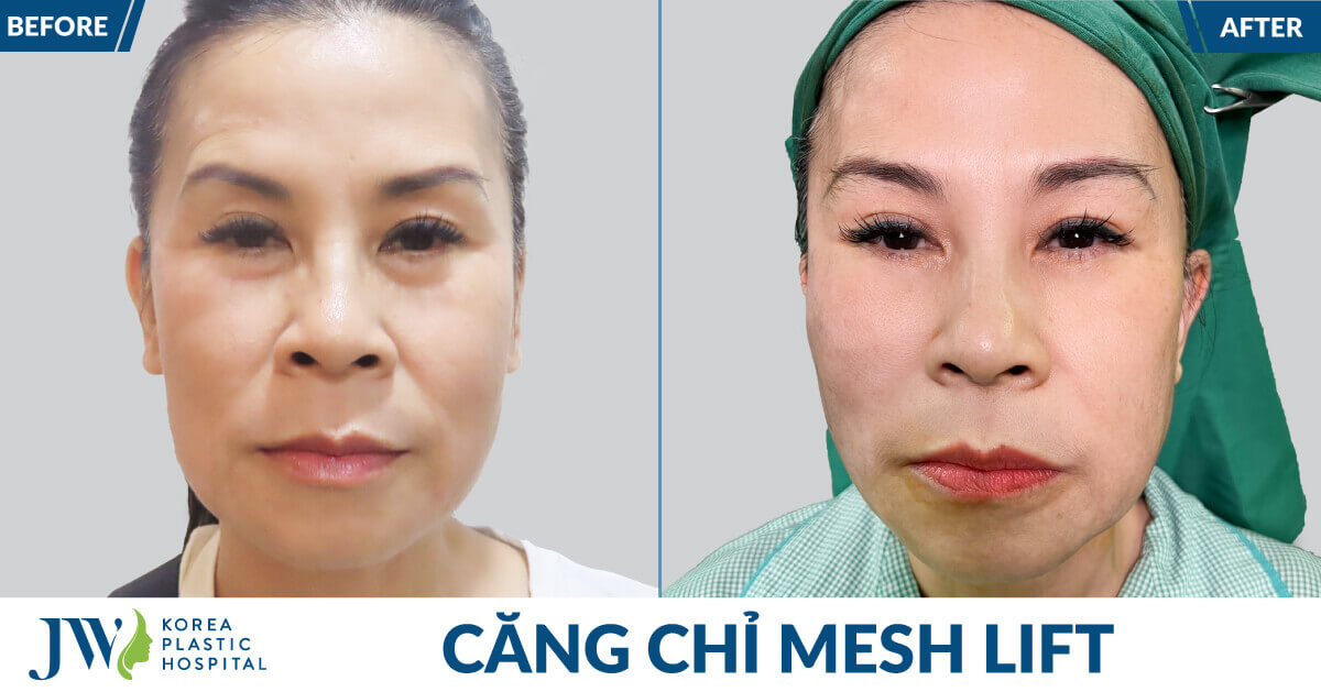 anh chinh dien truoc va sau