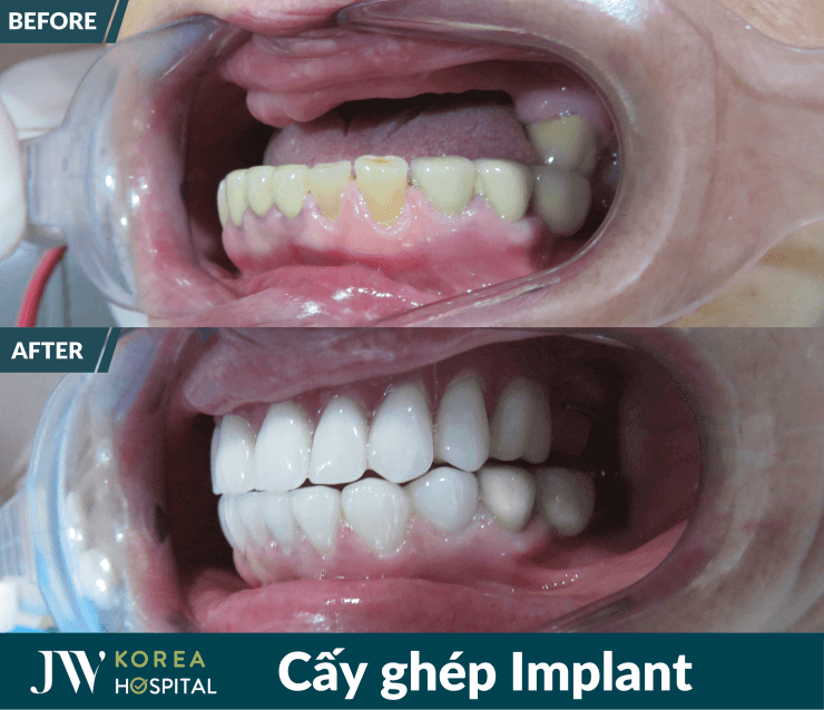 implant jw
