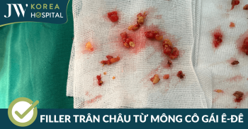 filler cua mong co gai e de