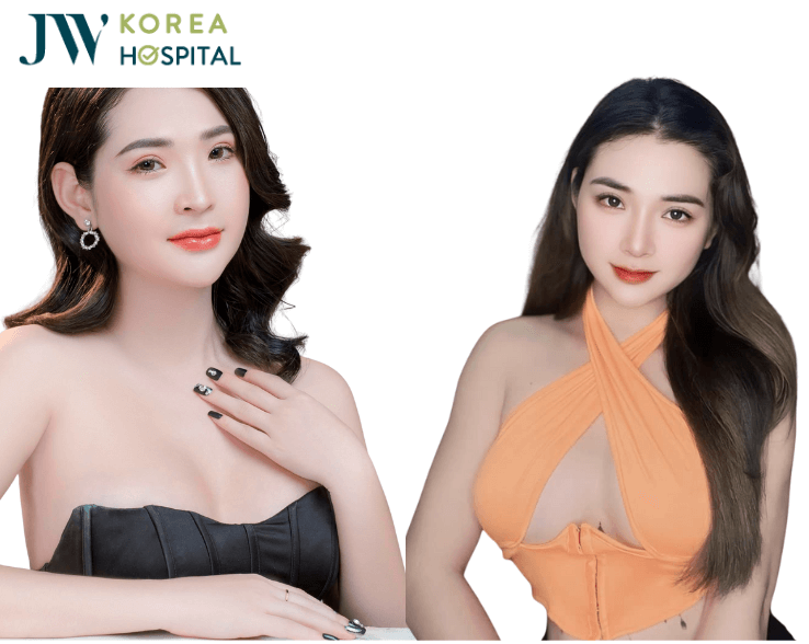 hình ảnh khách hàng nâng ngực chuyển giới an toàn tại JW