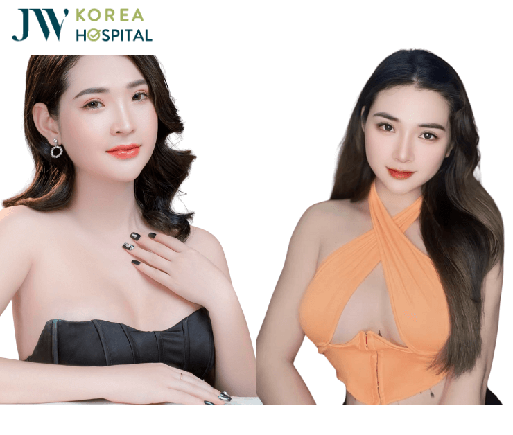 hình ảnh khách hàng nâng ngực chuyển giới