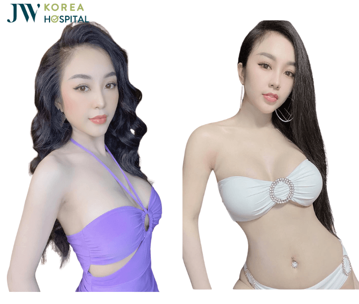 hình ảnh khách hàng nâng ngực Golden line