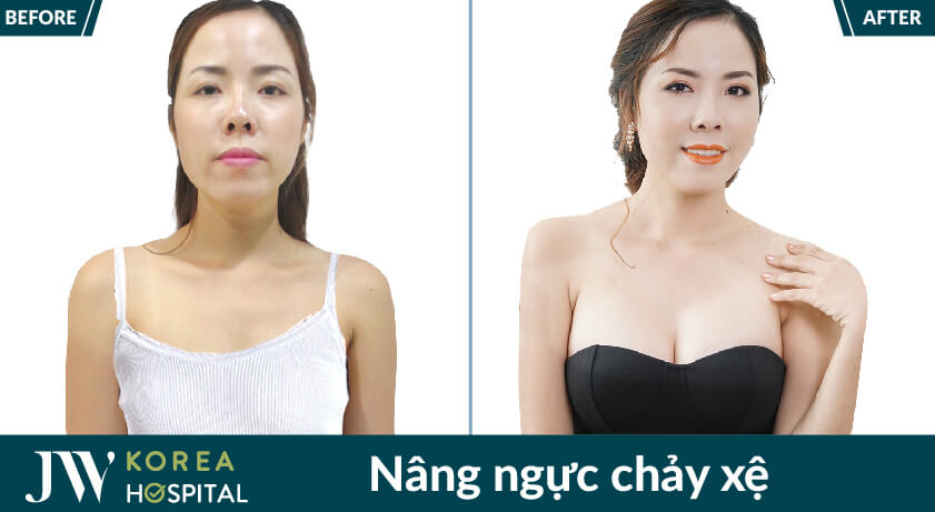 nâng ngực chảy xệ sau sinh cho mẹ bỉm sữa