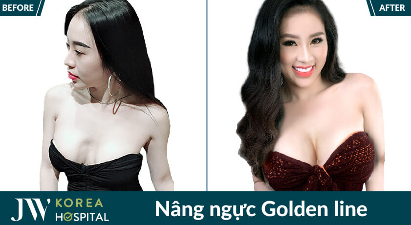 nâng ngực Golden line tái phẫu thuật ngực