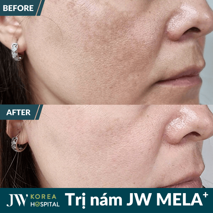Liệu trình trị nám JW MELA+