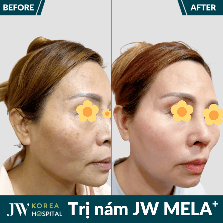 Hiệu quả vượt trội sau liệu trình trị nám tại JW