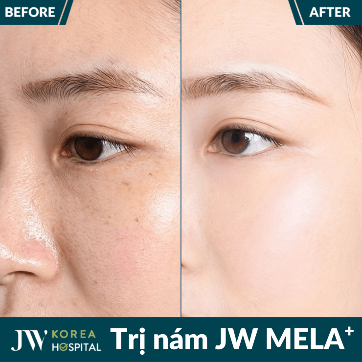 Liệu trình trị nám JW MELA+ tại Bệnh viện JW