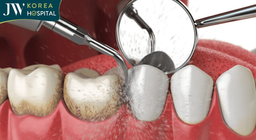 cạo vôi răng và tẩy trắng răng tại nha khoa bệnh viện jw
