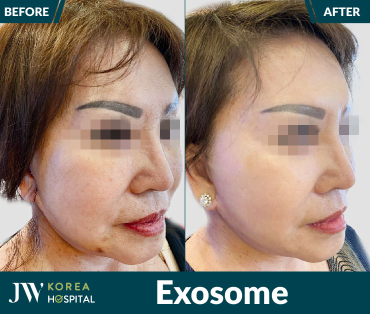 Lợi ích của công nghệ trẻ hóa Exosome tại Bệnh viện JW