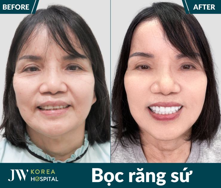 Khách hàng được bác sĩ có chứng chỉ hành nghề trực tiếp thăm khám và thực hiện bọc răng sứ tại Bệnh viện JW
