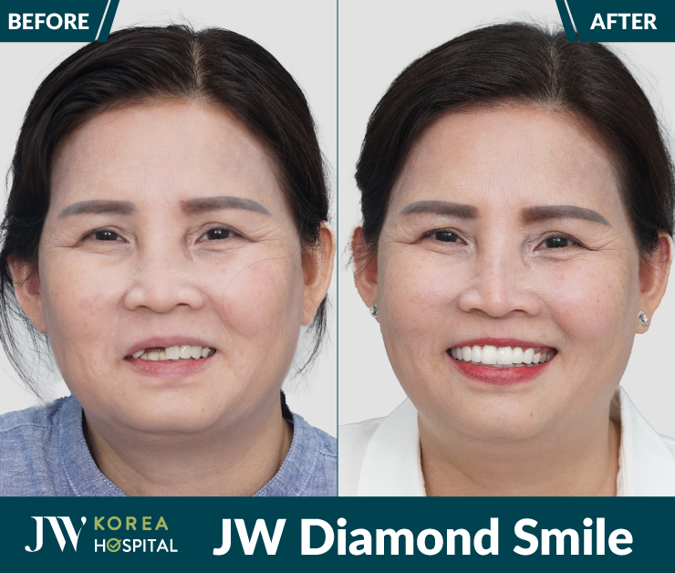 Hình ảnh trước và sau của khách hàng khi thực hiện bọc răng sứ kim cương JW Diamond Smile tại Bệnh viện JW
