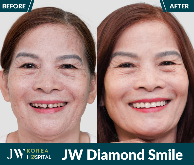 Kết quả Bọc răng sứ kim cương JW Diamond Smile