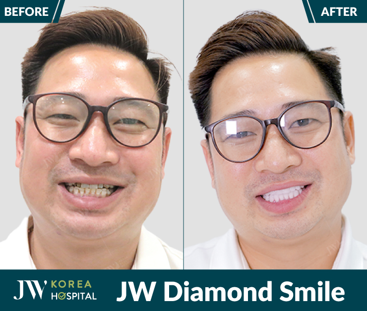 Răng sứ kim cương JW Diamond Smile giúp sở hữu nụ cười trắng sáng, tinh tế đẹp chuẩn giới thượng lưu