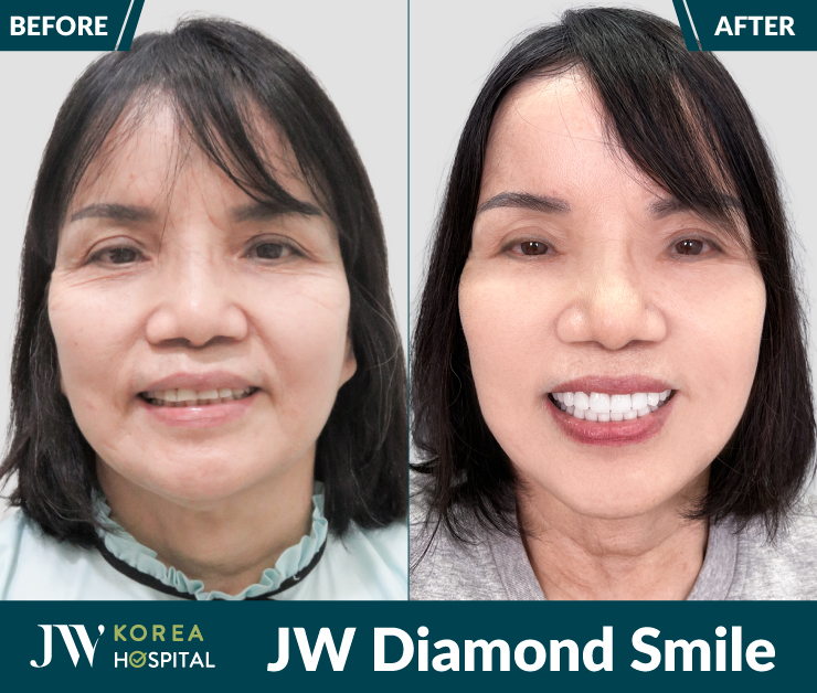 Răng sứ JW Diamond Smile tích hợp tinh thể nano kim cương, tạo hiệu ứng sáng tự nhiên cho nụ cười