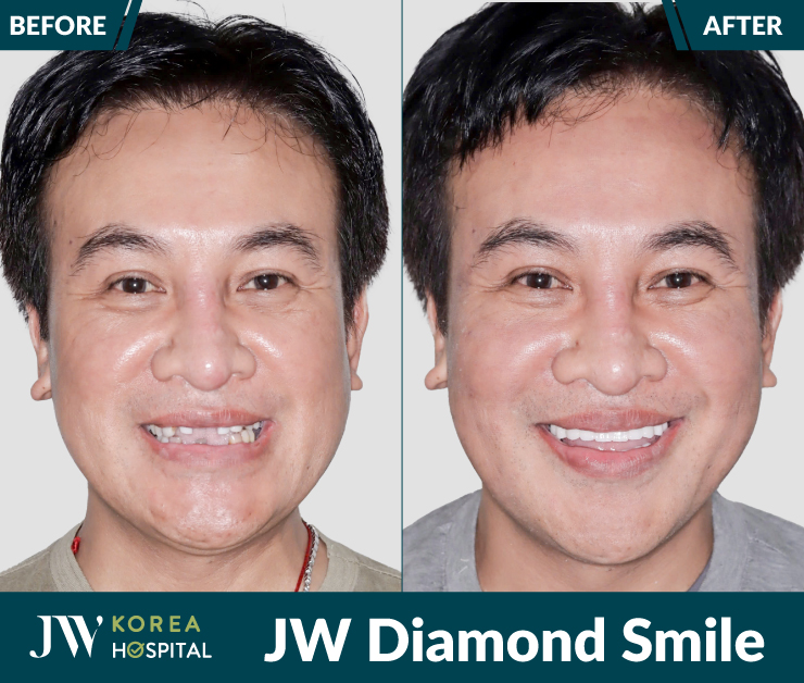 hình ảnh khách hàng trước và sau bọc răng sứ kim cương JW Diamond Smile tại Bệnh viện JW