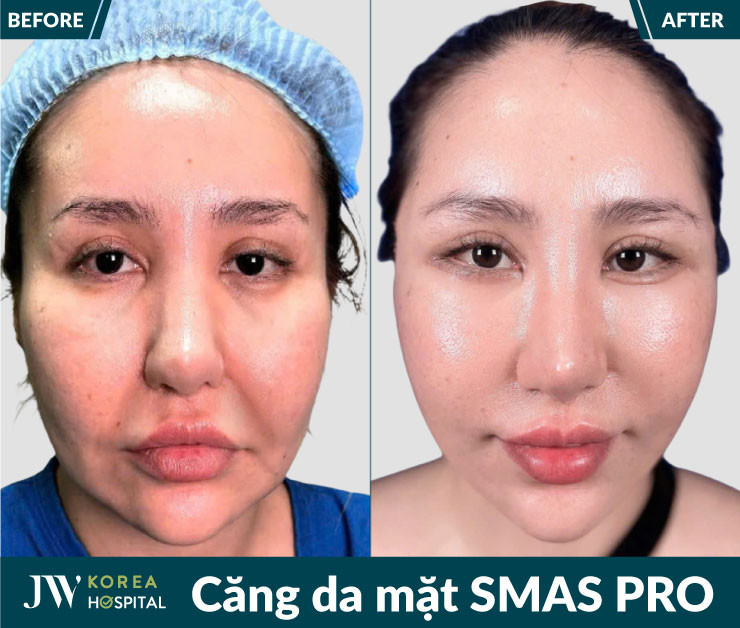 Hình ảnh trước và sau của khách hàng khi thực hiện căng da mặt Smas Pro tại bệnh viện JW