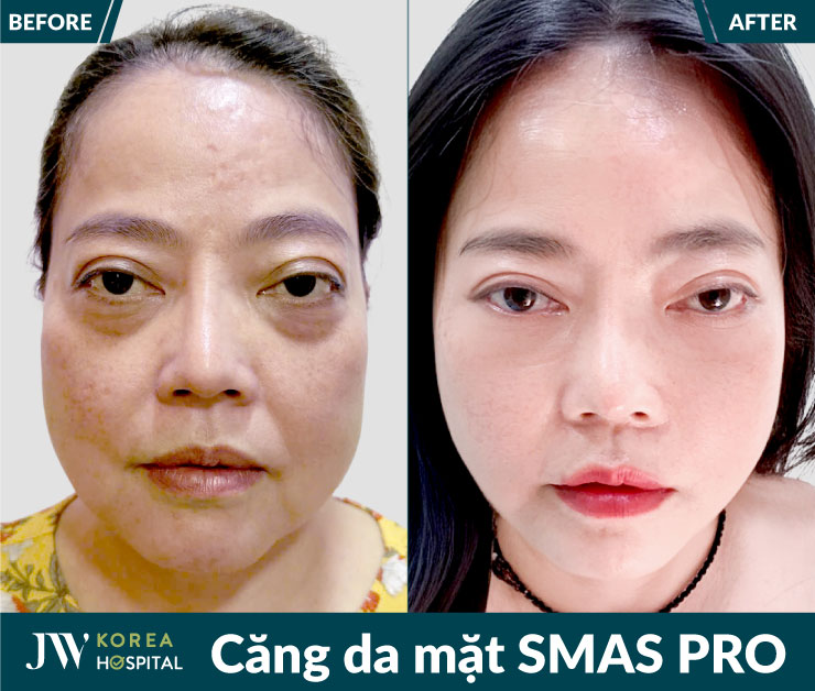 Kết quả căng da mặt Smas Pro tại bệnh viện JW