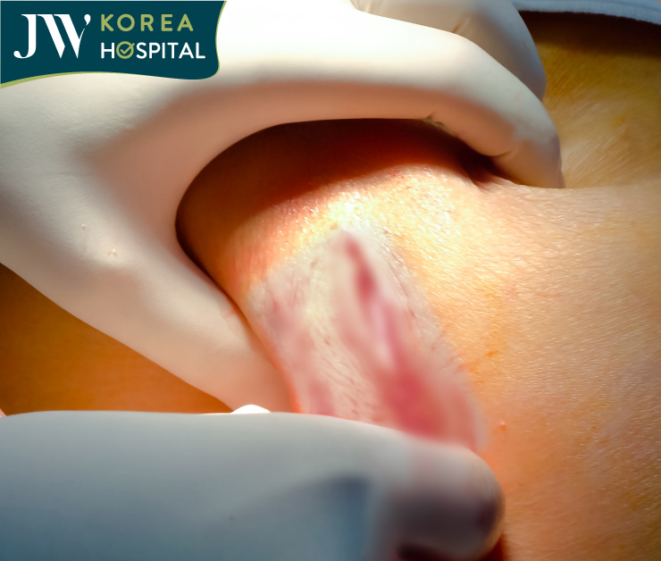 Bệnh nhân bị áp xe nhiễm trùng nặng sau 4 năm đặt túi độn mông tại cơ sở thẩm mỹ chui