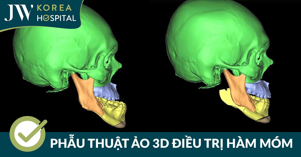 Bệnh viện JW ứng dụng công nghệ phẫu thuật ảo 3D trong điều trị hàm móm cho Soda Camp