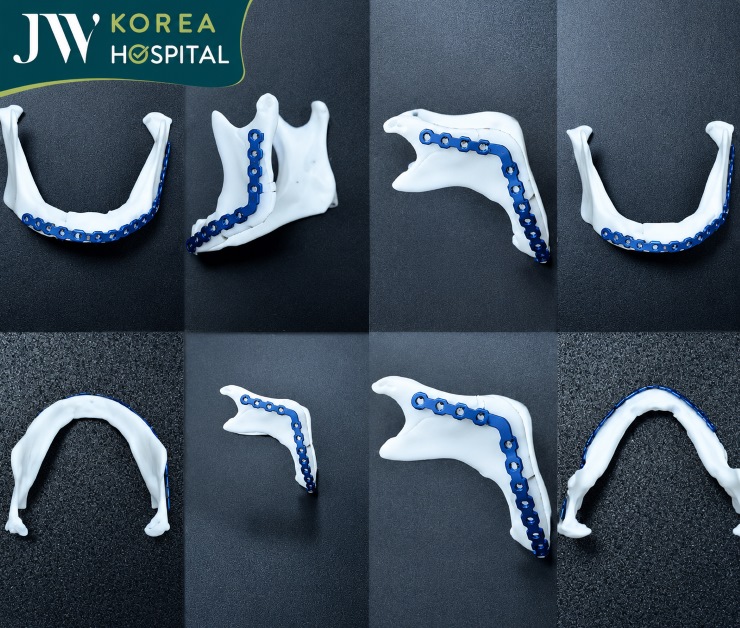 Công nghệ phẫu thuật hàm mặt 3D hỗ trợ thiết kế máng hướng dẫn phẫu thuật chính xác