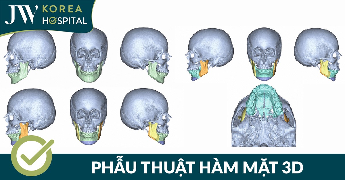 Hình ảnh mô phỏng phẫu thuật hàm mặt 3D giúp xác định vị trí di chuyển xương hàm