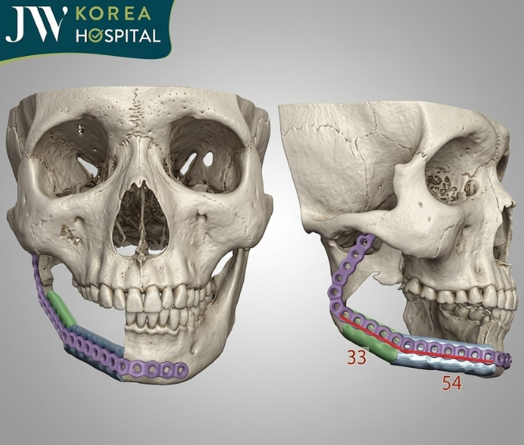 Mô hình xương hàm 3D được sử dụng để lên kế hoạch điều trị hàm móm do xương