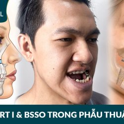Lefort I và BSSO trong phẫu thuật hàm móm sai khớp cắn độ III