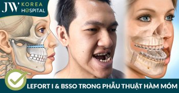 Lefort I và BSSO trong phẫu thuật hàm móm sai khớp cắn độ III