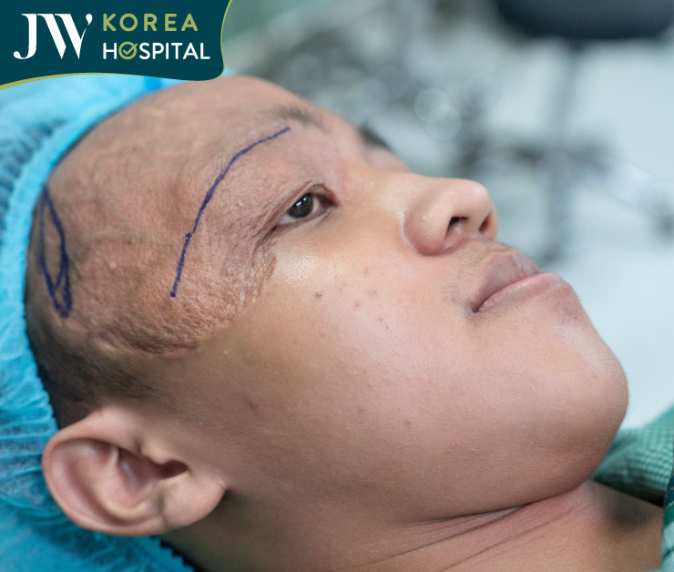 Gương mặt nam sinh trước phẫu thuật với phần da dư che phủ mắt phải do u máu bẩm sinh