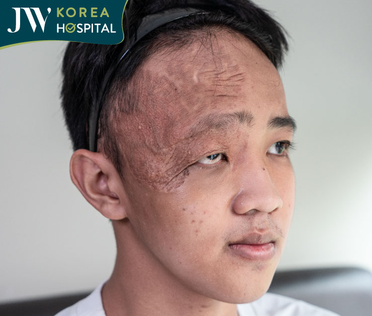 ình ảnh nam sinh 16 tuổi mang di chứng u máu bẩm sinh vùng mặt trước khi điều trị tại Bệnh viện JW